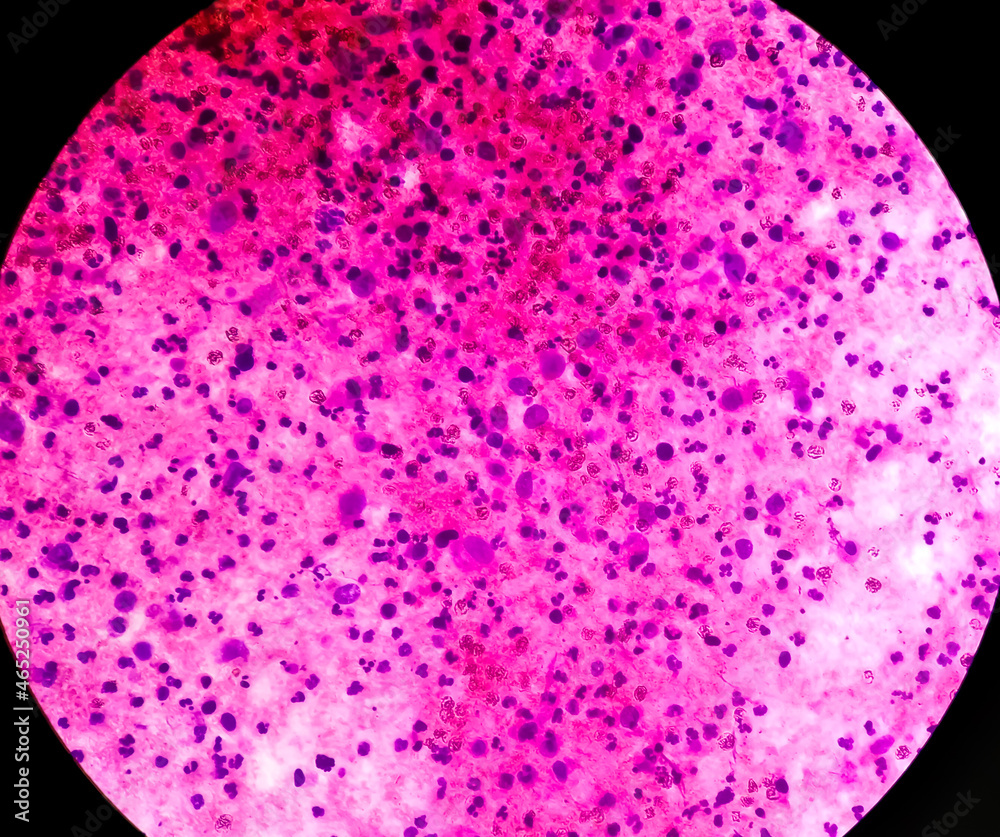 Foto de Malignant effusion (cancer cells): Pleural fluid cytology of ...