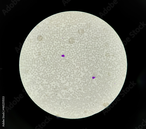 Acute thrombocytopenia and leucocytopenia. Close up Micrograph of dengue virus fever patient at medical laboratory. photo