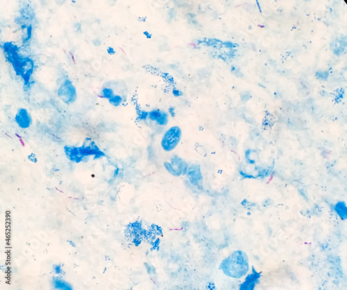 Bacteria Mycobacterium tuberculosis, the causative agent of tuberculosis, can be used for M. leprae, M. avium complex and other mycobacteria, Sputum Ziehl-Neelsen (ZN) stained AFB micrograph photo