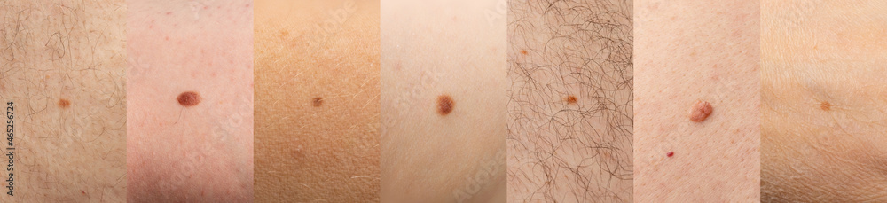 Fototapeta premium Skin mole closeup. Macro photo of blemish similar to melanoma