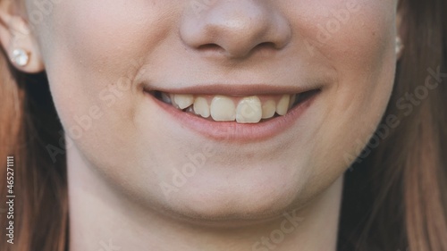 A young girl smiles and shows her crooked teeth.