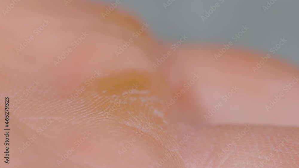 MACRO, DOF: Hard callouses formed on the palm of an unrecognizable male climber. Detailed shot of a worker's hardened skin on the inside of their hands caused by heavy manual labor. Hardened skin. MACRO, DOF: Hard callouses formed on the palm of an unrecognizable male climber. Detailed shot of a worker's hardened skin on the inside of their hands caused by heavy manual labor. Hardened skin.