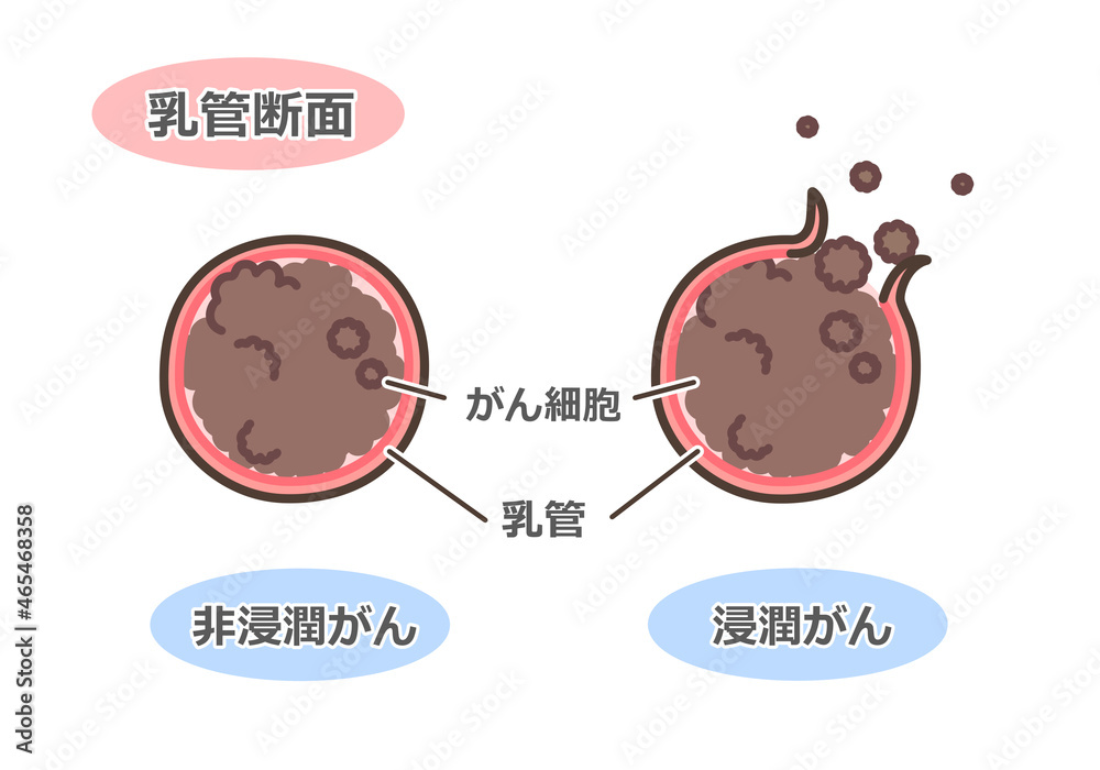 乳がんの乳管断面図 Stock-Illustration | Adobe Stock