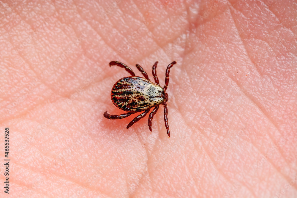 Infectious Encephalitis Tick Insect on Skin. Encephalitis Virus or Lyme Borreliosis Disease Infected Dermacentor Tick Arachnid Parasite Bite Close-up.