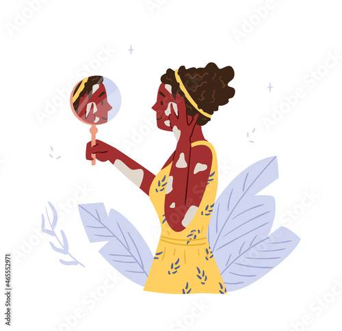 African american woman with vitiligo looking in mirror flat vector illustration. Isolated on white. Body positive and self acceptance concept.