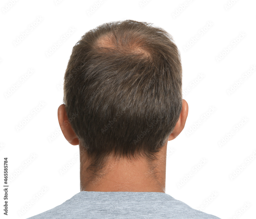Man with hair loss problem on white background, back view Man with hair loss problem on white background, back view