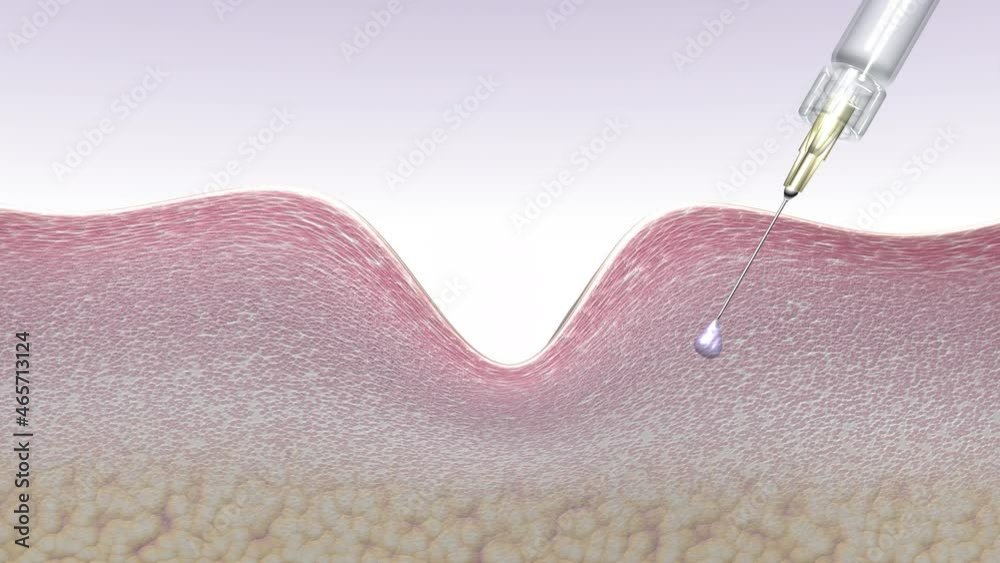 Skin rejuvenation with hyaluronic acid fillers. Injection of the drug stimulates collagen synthesis and reduces wrinkles.3D animation ad for anti-aging treatment, spa procedures, Radiesse drug