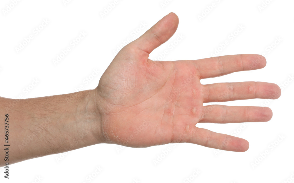 Man suffering from calluses on hand against white background, closeup Man suffering from calluses on hand against white background, closeup