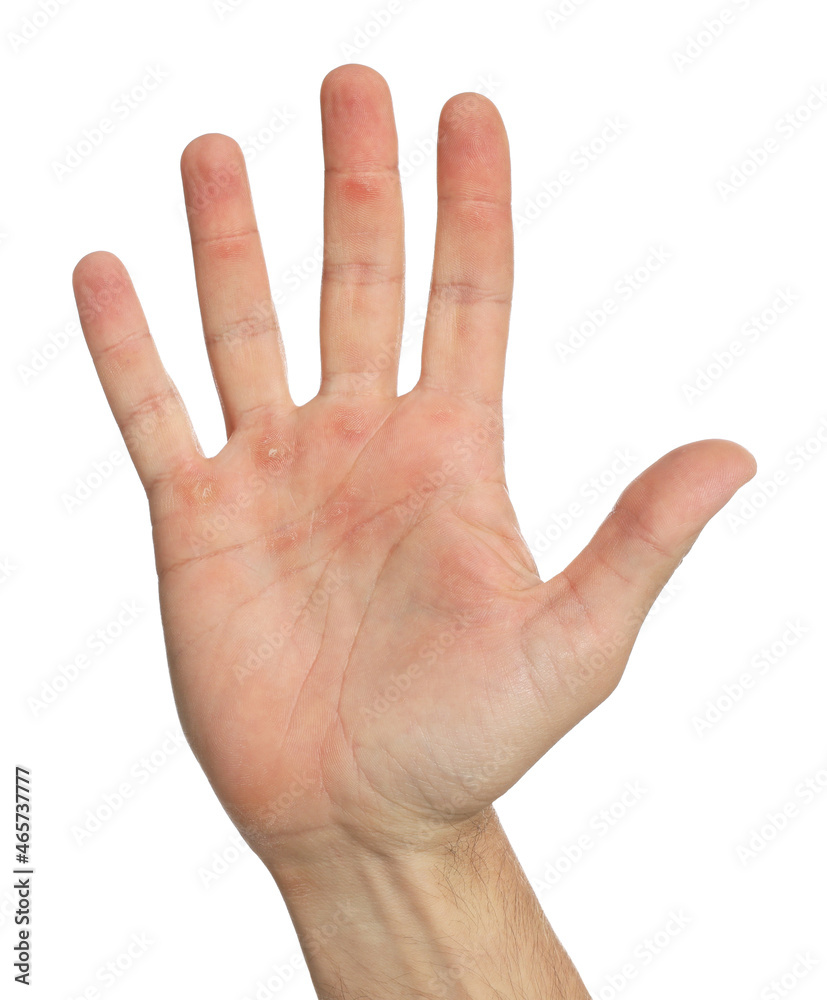 Man suffering from calluses on hand against white background, closeup Man suffering from calluses on hand against white background, closeup