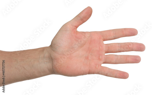 Man suffering from calluses on hand against white background, closeup