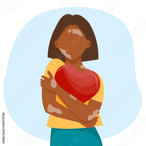 Vitiligo woman with heart. Concept of skin depigmentation, body positive. World vitiligo day. 