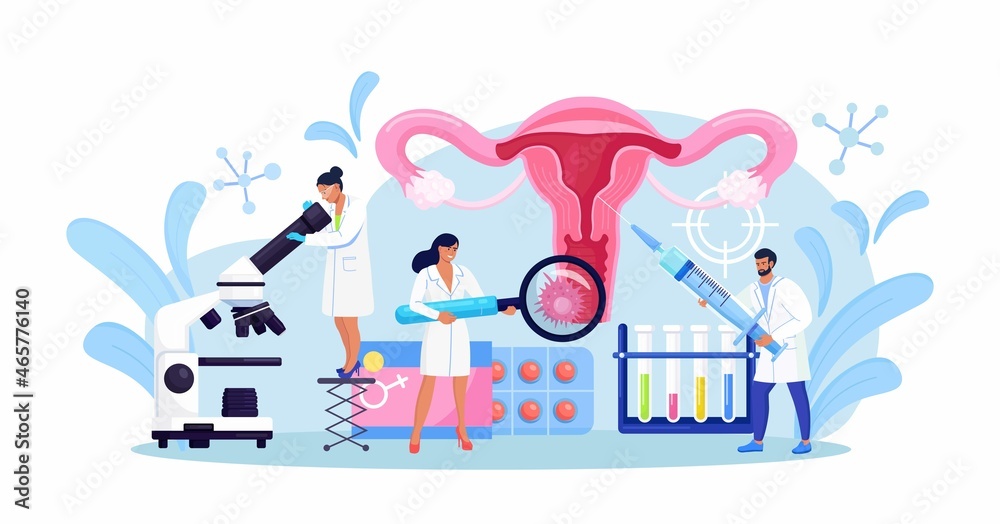 Cancer of cervix, papillomavirus. Tiny doctors examine uterus with magnifier to treat cervical cancer,  cauterize erosion, diagnosis papilloma. HPV vaccination. Gynecology, female disease. Vector 