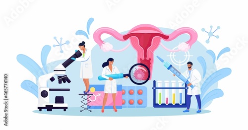 Cancer of cervix, papillomavirus. Tiny doctors examine uterus with magnifier to treat cervical cancer,  cauterize erosion, diagnosis papilloma. HPV vaccination. Gynecology, female disease. Vector  photo