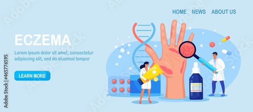 Dermatologist Exam Big Hand with Red Skin and Ras. Psoriasis, Vitiligo, Dermatitis. Eczema - Inflammation Skin Disease. Consequences of Improper Care, Frequent Hand Washing Disinfection. Vector design photo