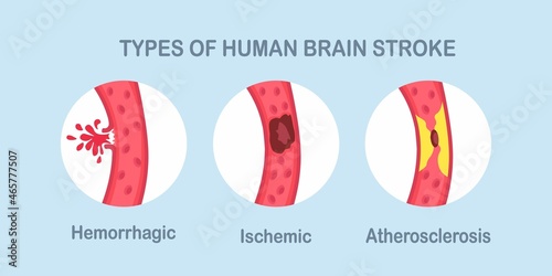Types of human brain stroke. Ischemic, atherosclerosis and hemorrhagic stroke disease. Vector illustration
