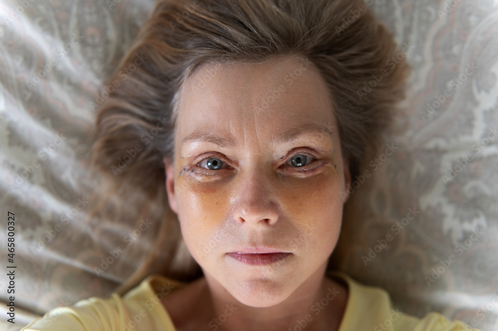 Middle-aged woman selfie seven days after Double Eyelid blepharoplasty surgery. Middle-aged woman selfie seven days after Double Eyelid blepharoplasty surgery.