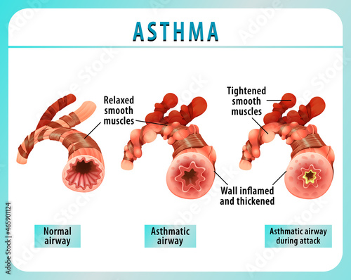 Bronchial Asthma diagram with normal airway and asthmatic airway