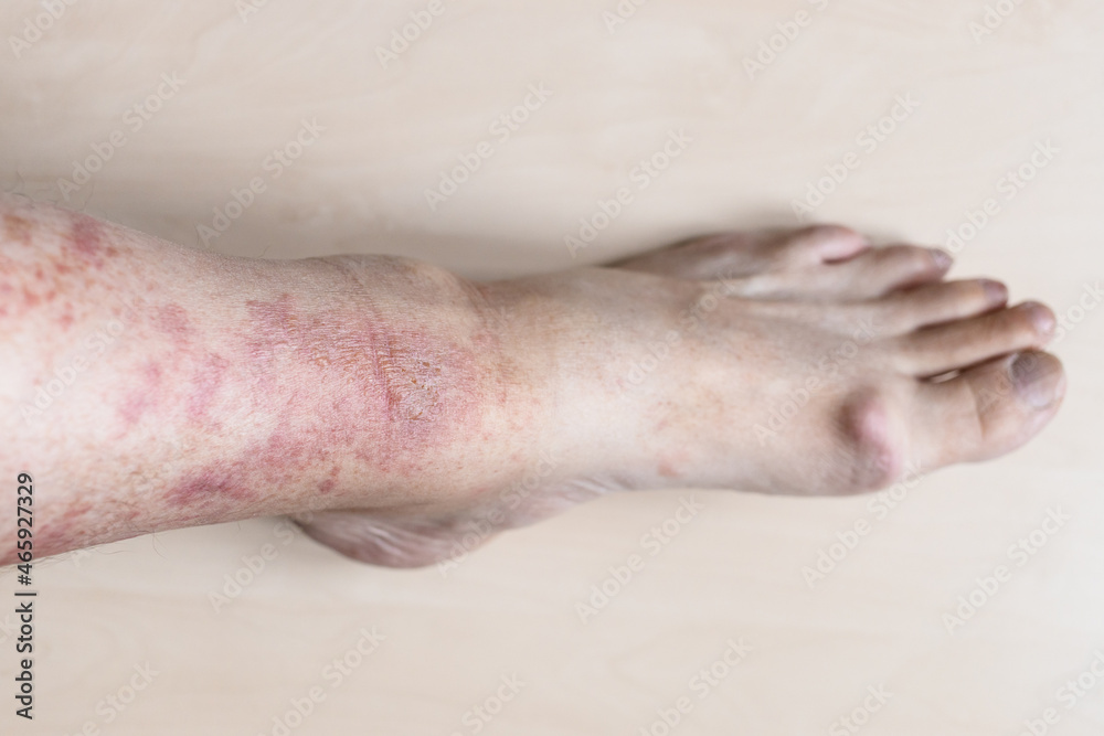 sample of Allergic contact dermatitis - male shin with redness and itchy rash on skin sample of Allergic contact dermatitis - male shin with redness and itchy rash on skin