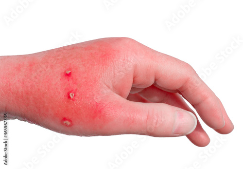 Infected domestic cat bite with redness and swelling