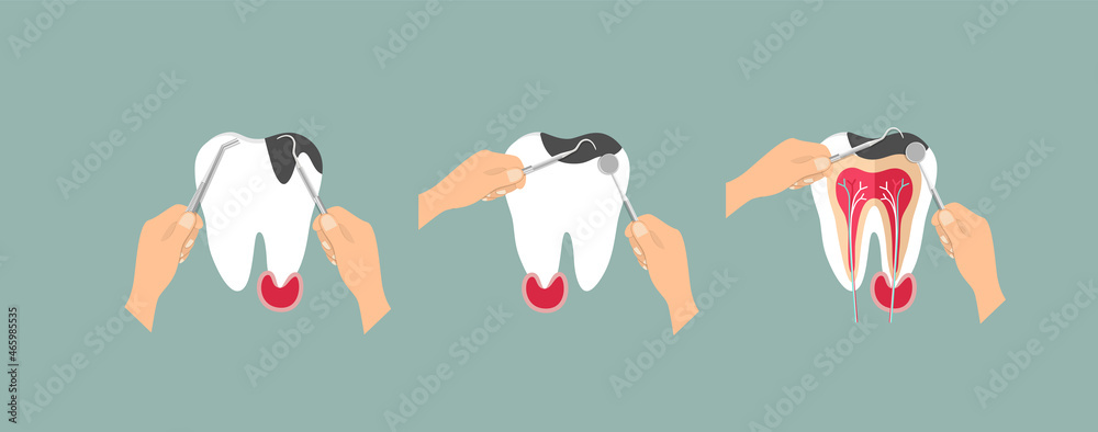 Hand holding instruments for examining patient teeth. Teeth examination dentistry concept. 