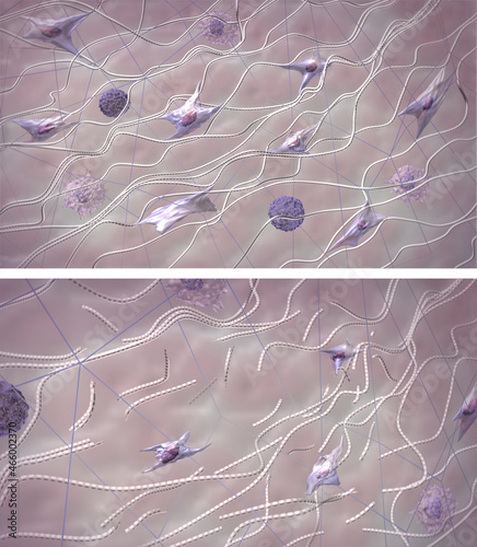 Collagen destruction process. Comparison skin extracellular matrix structure in young healthy skin and aging skin.  Medical 3D illustration photo