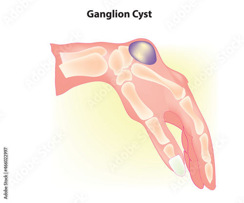Biological illustration of ganglion cyst
