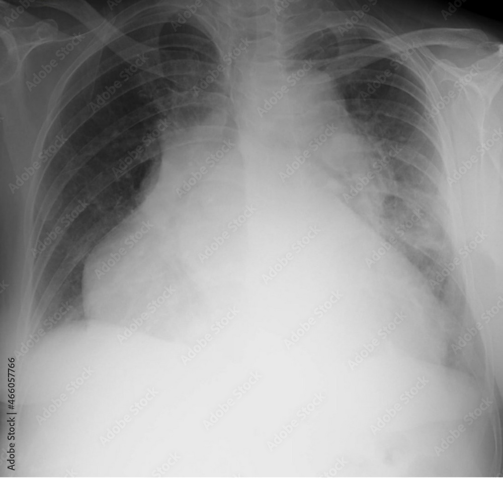 X ray image of a cardiomegaly.heart enlargement X ray image of a cardiomegaly.heart enlargement
