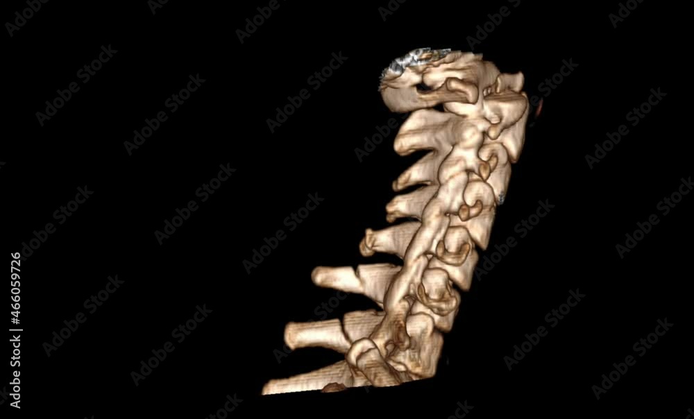 cervical subluxation 3d ct .atlantoaxial dislocation 3d ct scan Stock ...