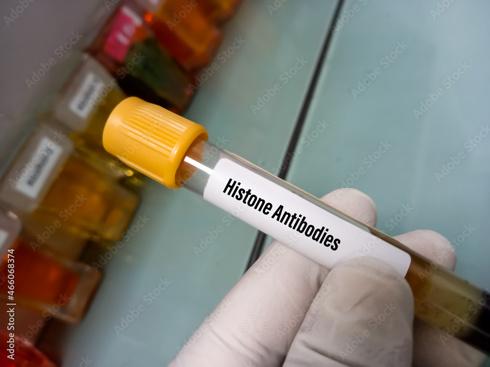 Blood sample for histone antibody test, diagnosis and monitoring of
