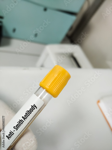 Blood sample for Anti Smith Antibodies test, diagnosis and monitoring of SLE and MCTD disease,