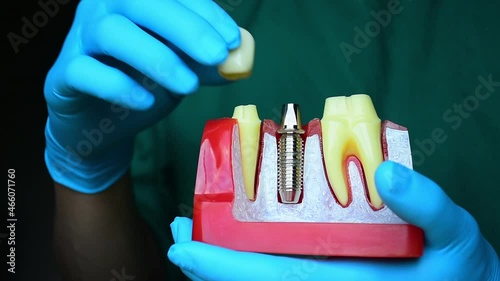 Close-up photo of implant dentistry it is a replacement for missing teeth by dentist hand.