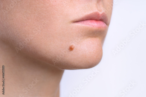 Mole on face. Young woman face with birthmark or nevus. Copy space photo