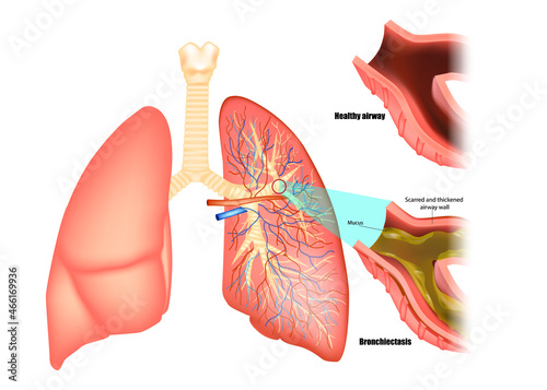 Illustration of lungs affected by bronchiectasis disease. Obstructive lung disease photo