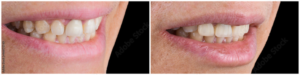 Obraz premium press ceramic crowns and veneers