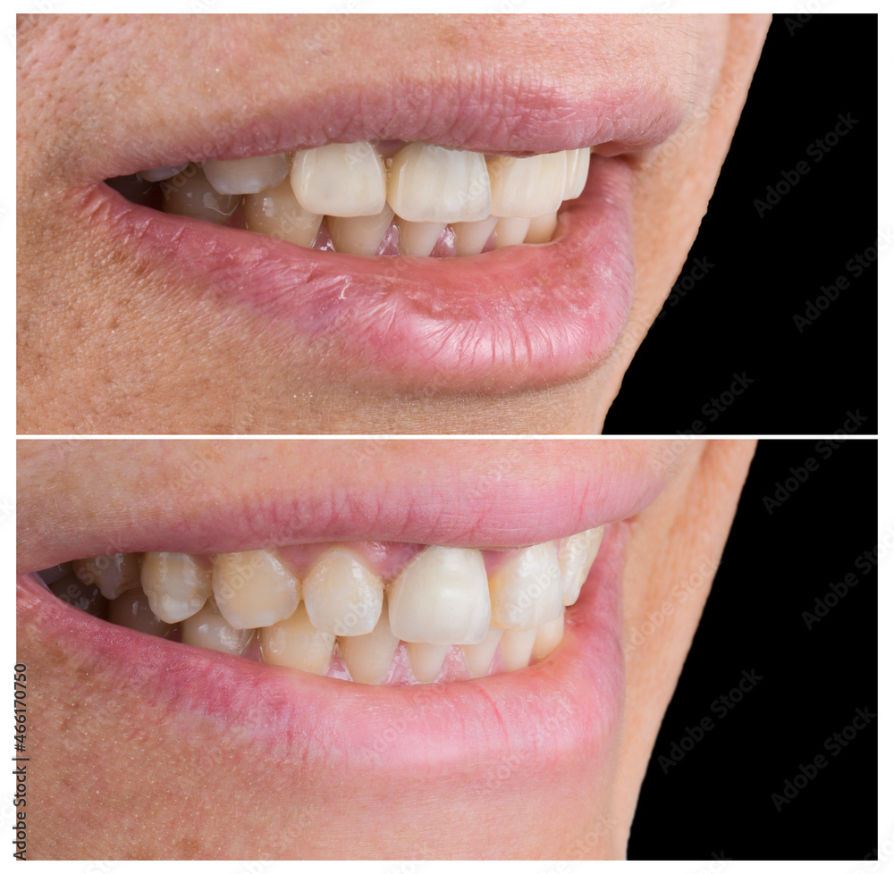 Fototapeta premium press ceramic crowns and veneers