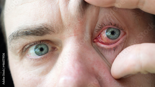 Ophthalmologist Office - Doctor Looks at Male Patient with Red Inflamed Eyes with Conjunctivitis or After an Allergy. Close Up of Man with Sore Eyes. Irritated, Infected, Inflammation of Eye. Close-Up