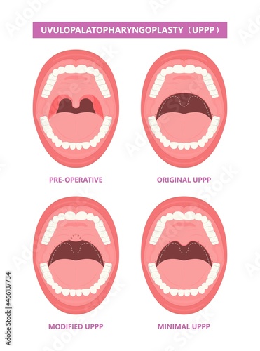 UPPP laser assisted sleep apnea OSA surgery treat tonsil uvula Uvulo Palato Pharyngo Plasty Snoring Oral Excision throat remove mouth Jaw airway study block Nasal obstruction © Pepermpron