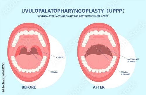UPPP laser assisted sleep apnea OSA surgery treat tonsil uvula Uvulo Palato Pharyngo Plasty Snoring Oral Excision throat remove mouth Jaw airway study block Nasal obstruction
