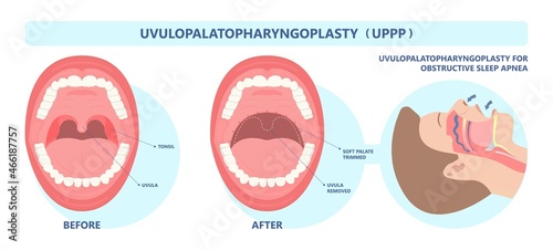 UPPP laser assisted sleep apnea OSA surgery treat tonsil uvula Uvulo Palato Pharyngo Plasty Snoring Oral Excision throat remove mouth Jaw airway study block Nasal obstruction