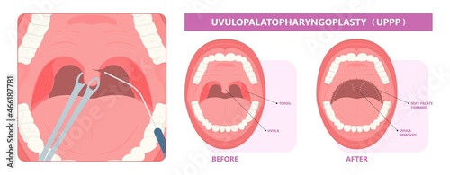 UPPP laser assisted sleep apnea OSA surgery treat tonsil uvula Uvulo Palato Pharyngo Plasty Snoring Oral Excision throat remove mouth Jaw airway study block Nasal obstruction