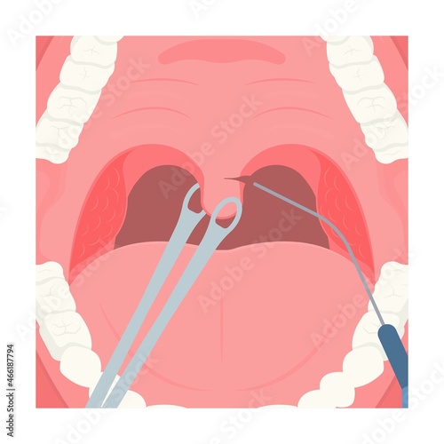 UPPP laser assisted sleep apnea OSA surgery treat tonsil uvula Uvulo Palato Pharyngo Plasty Snoring Oral Excision throat remove mouth Jaw airway study block Nasal obstruction photo
