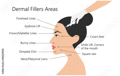 Dermal filler and botox injections areas. Woman face with doctor hands in gloves with syringe. Beauty lifting anti-aging treatment vector illustration.
