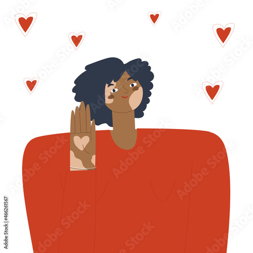 Dark-skinned girl with vitiligo spots showing open palm. There are hearts flying in the background. Concept of friendly attitude to people with skin problems. Flat vector illustration