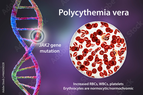 Polycythemia vera, a rare slow-growing blood cancer with an increase in the number of red blood cells photo