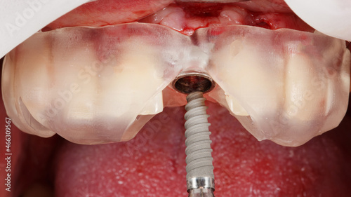 Moment input of the implant Dental in a surgical template for central tooth restoration
