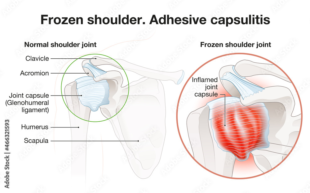 Frozen shoulder. Adhesive capsulitis surgery. Labeled Illustration