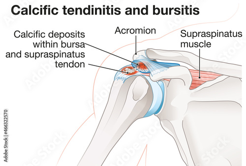 Shoulder joint. Calcific tendinitis and bursitis photo