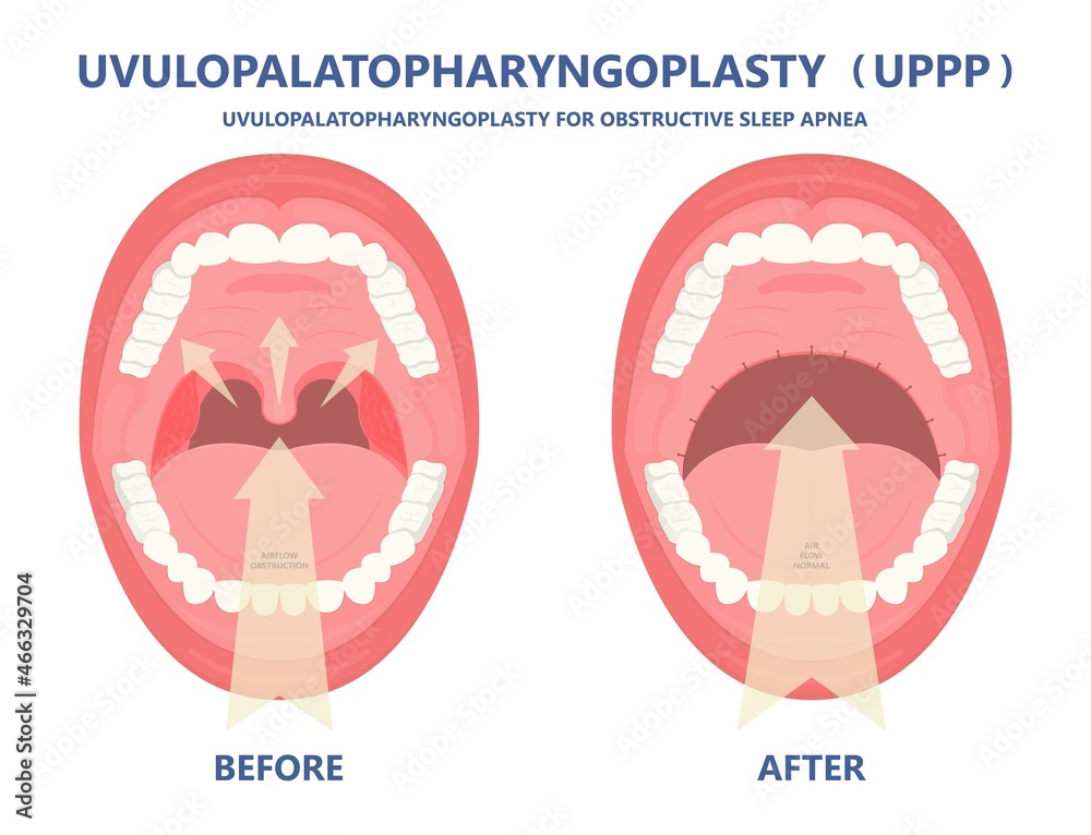 Somnoplasty sale