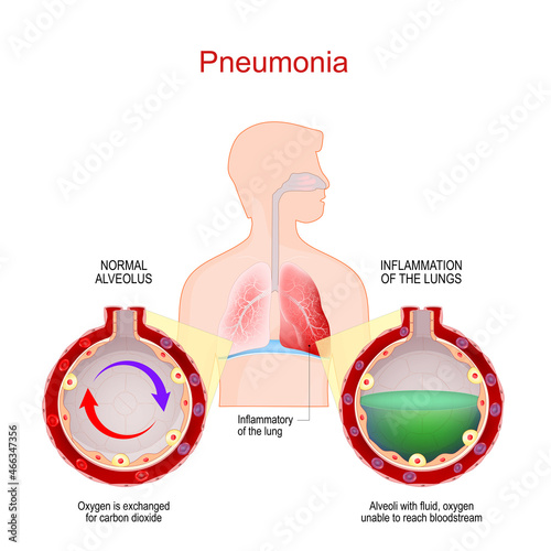 Pneumonia. Lung infection. Alveoli with fluid