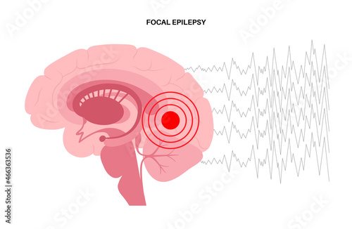 epilepsy seizure concept